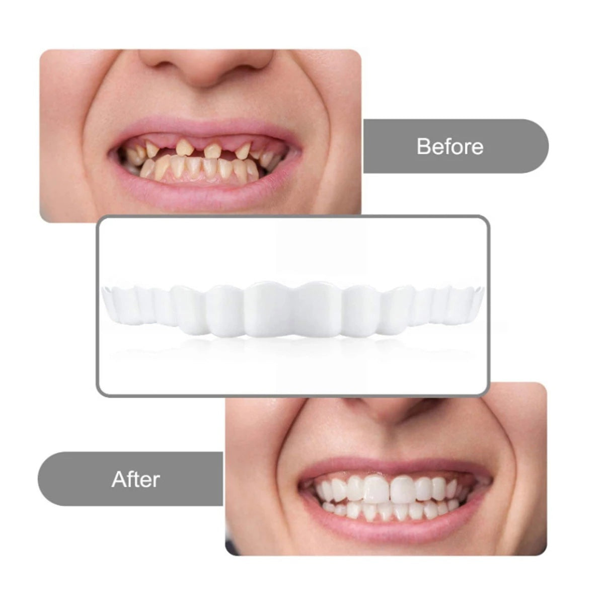 Carillas snap on smile dientes