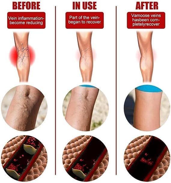 PARCHES PARA VARICES VEINS